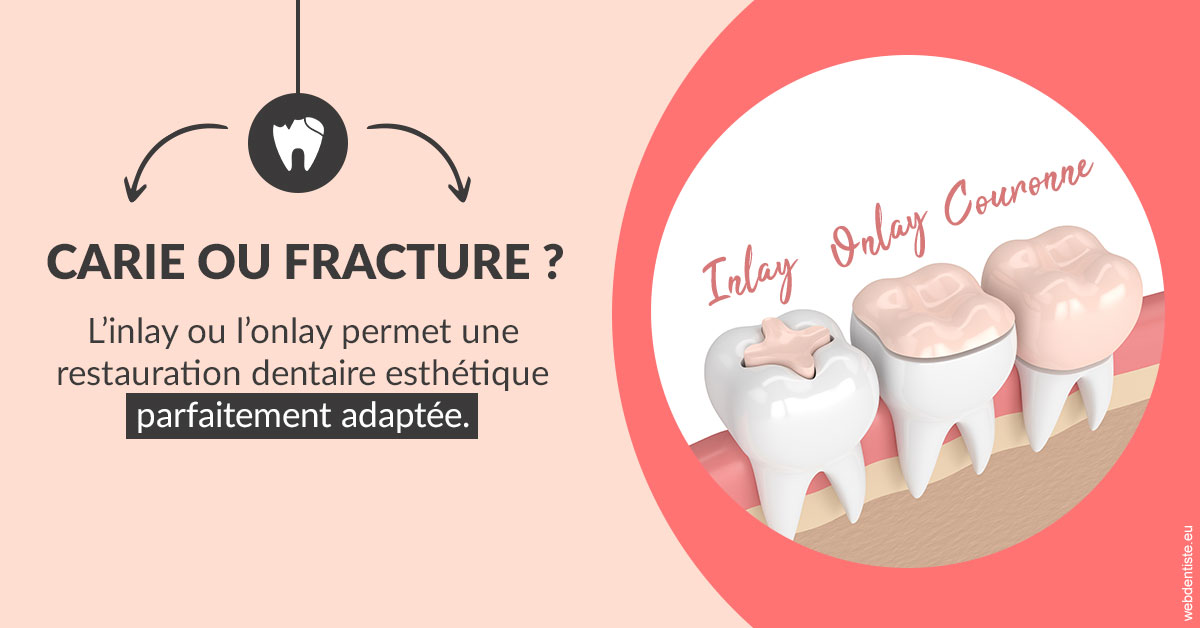 https://dr-patrice-drancourt.chirurgiens-dentistes.fr/T2 2023 - Carie ou fracture 2
