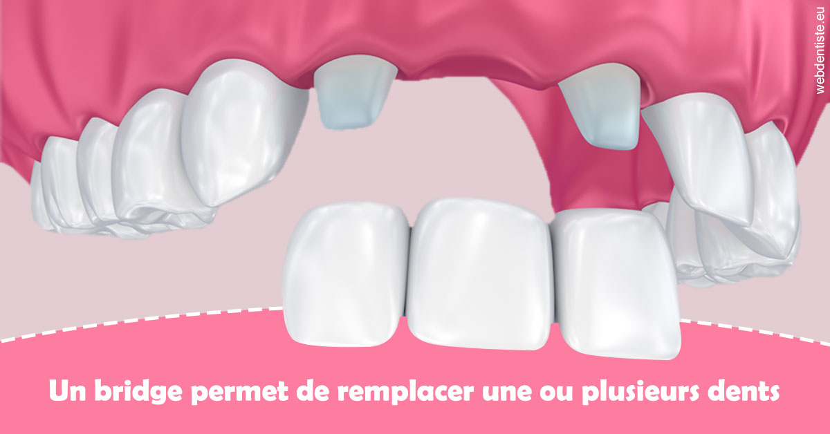 https://dr-patrice-drancourt.chirurgiens-dentistes.fr/Bridge remplacer dents 2