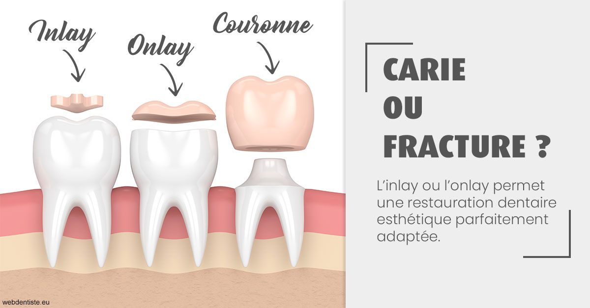https://dr-patrice-drancourt.chirurgiens-dentistes.fr/T2 2023 - Carie ou fracture 1