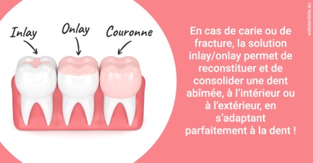 https://dr-patrice-drancourt.chirurgiens-dentistes.fr/L'INLAY ou l'ONLAY 2
