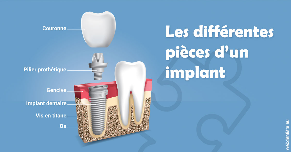 https://dr-patrice-drancourt.chirurgiens-dentistes.fr/Les différentes pièces d’un implant 1